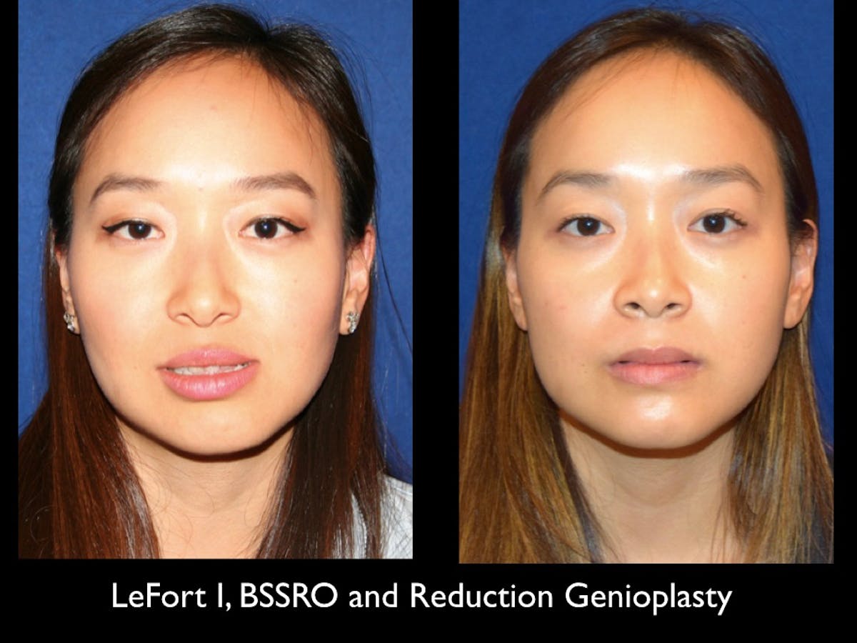 Chin Augmentation Before & After Gallery - Patient 79206066 - Image 1