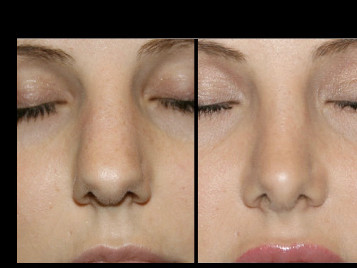 Rhinoplasty Before & After Gallery - Patient 79206561 - Image 1
