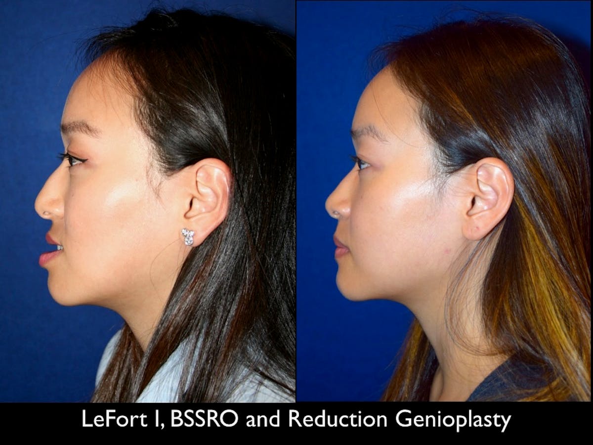 Chin Augmentation Before & After Gallery - Patient 79206066 - Image 2