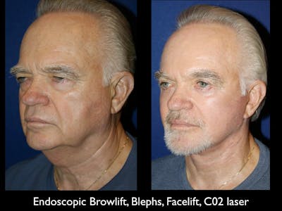 Brow Lift Before & After Gallery - Patient 79206179 - Image 1