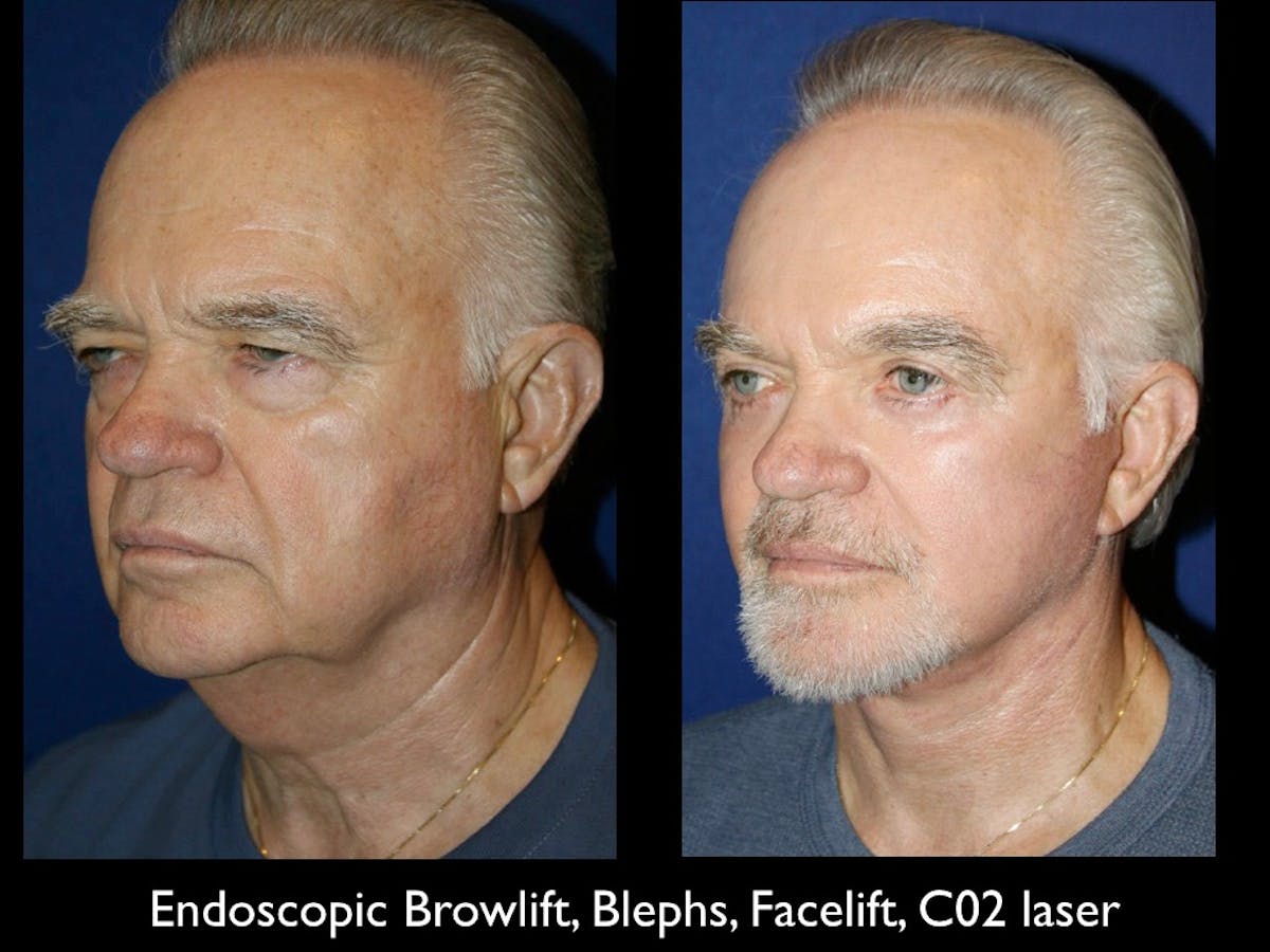 Brow Lift Before & After Gallery - Patient 79206179 - Image 1