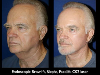Facelift Before & After Gallery - Patient 79206521 - Image 1