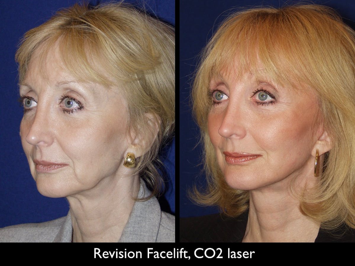 Facelift Before & After Gallery - Patient 79206522 - Image 1