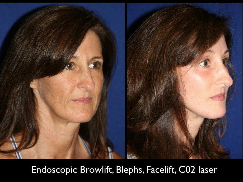 Blepharoplasty Before & After Gallery - Patient 79206479 - Image 2