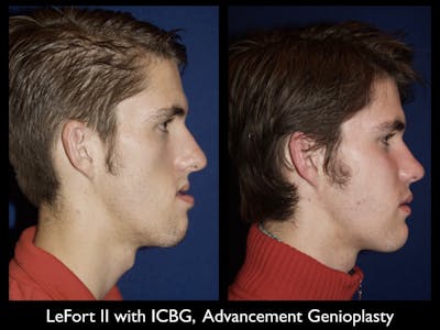 Chin Augmentation Before & After Gallery - Patient 79206070 - Image 1