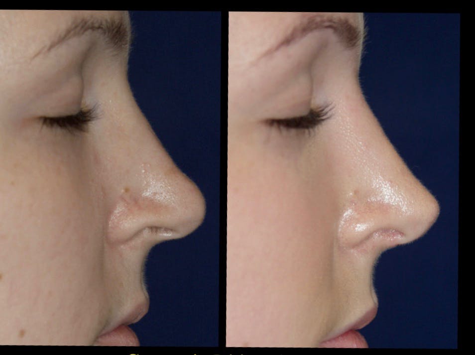 Rhinoplasty Before & After Gallery - Patient 79206565 - Image 1