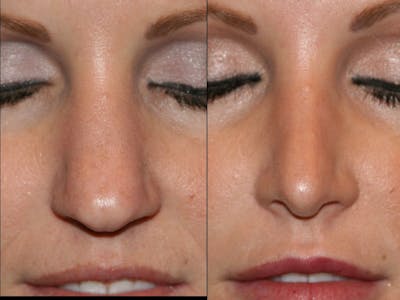 Rhinoplasty Before & After Gallery - Patient 79206566 - Image 1