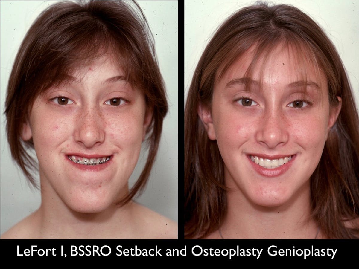 Chin Augmentation Before & After Gallery - Patient 79206060 - Image 2