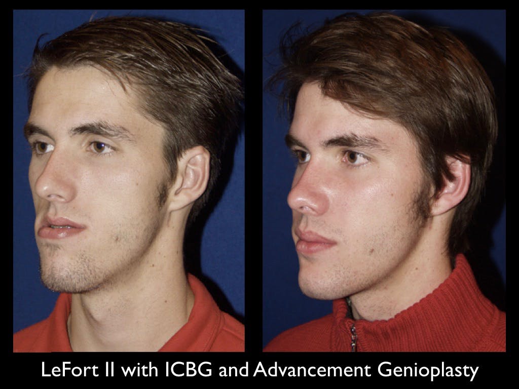 Chin Augmentation Before & After Gallery - Patient 79206070 - Image 2