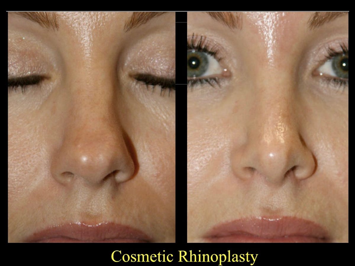 Rhinoplasty Before & After Gallery - Patient 79206567 - Image 1