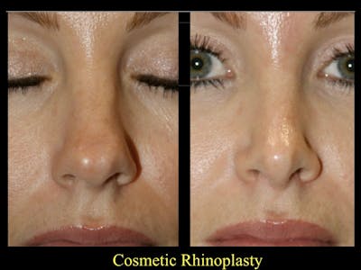 Rhinoplasty Before & After Gallery - Patient 79206567 - Image 1