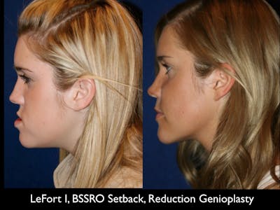 Chin Augmentation Before & After Gallery - Patient 79206074 - Image 1