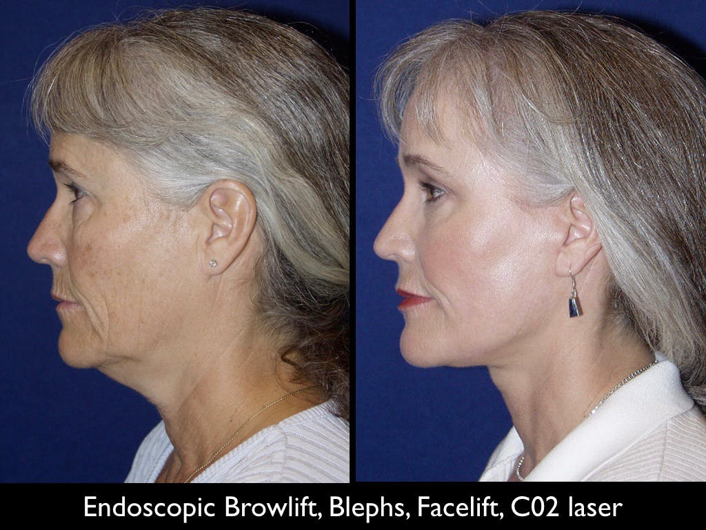 Brow Lift Before & After Gallery - Patient 79206186 - Image 1