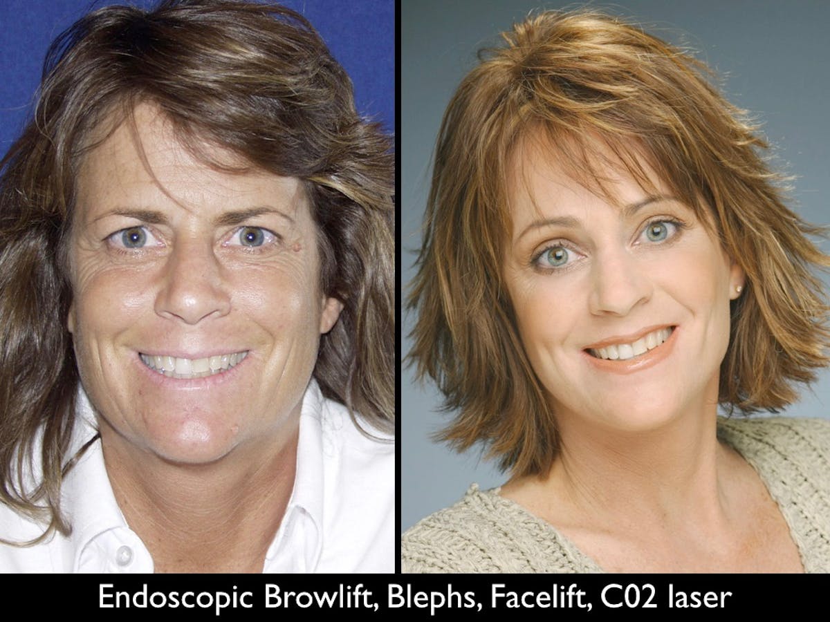 Brow Lift Before & After Gallery - Patient 79206187 - Image 1