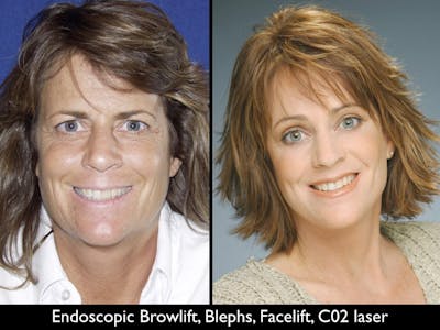Blepharoplasty Before & After Gallery - Patient 79206490 - Image 1