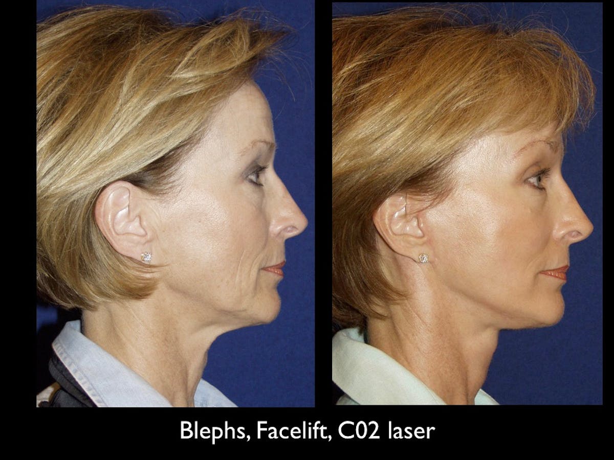 Facelift Before & After Gallery - Patient 79206530 - Image 1