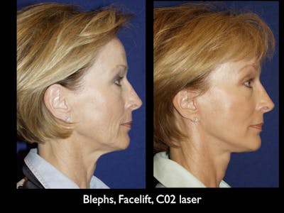 Facelift Before & After Gallery - Patient 79206530 - Image 1