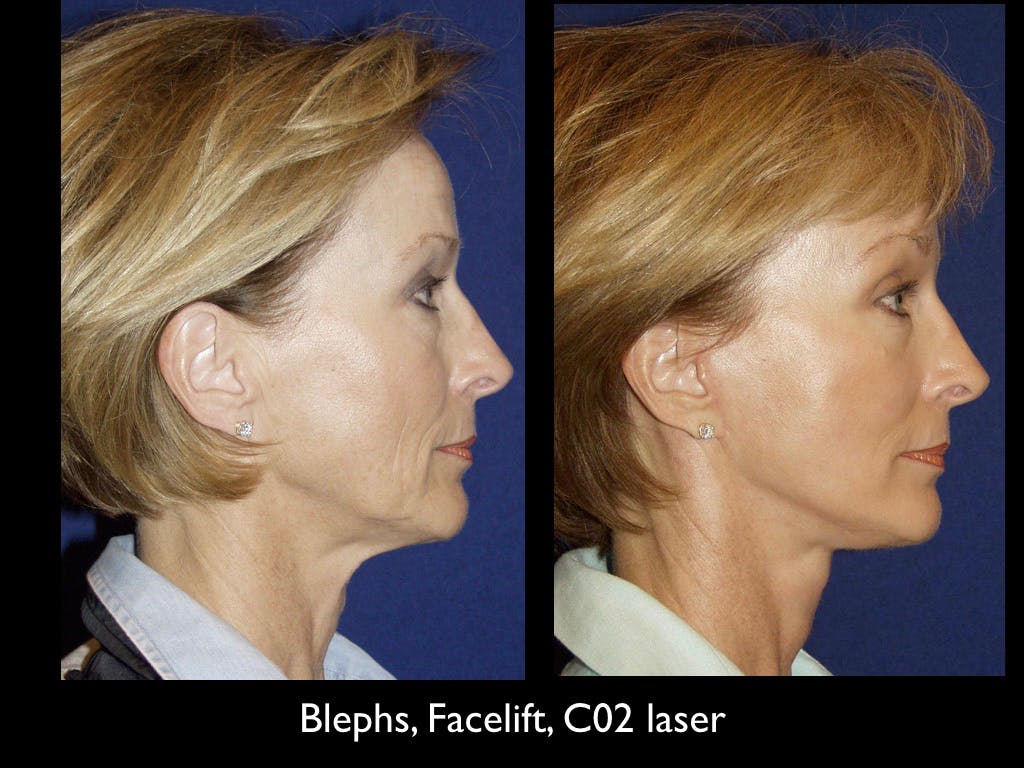 Blepharoplasty Before & After Gallery - Patient 79206491 - Image 1