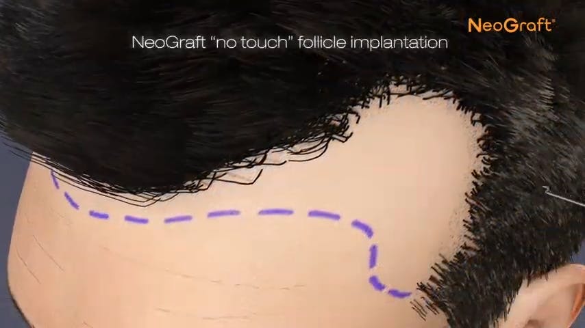 an animation showing NeoGraft implantation grid
