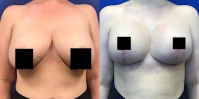 Breast Lift Before & After Gallery - Patient 98126944 - Image 1