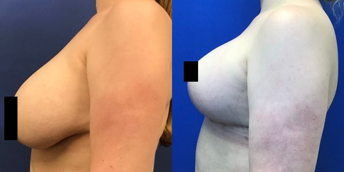 Breast Lift Before & After Gallery - Patient 98126944 - Image 2