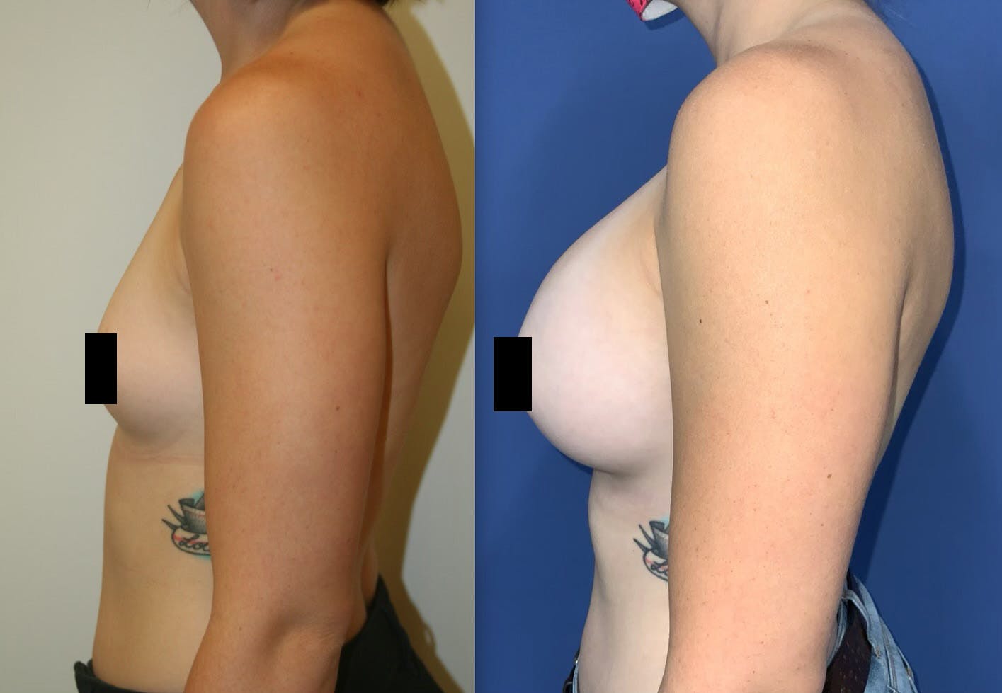 Breast Augmentation Before & After Gallery - Patient 157147218 - Image 4