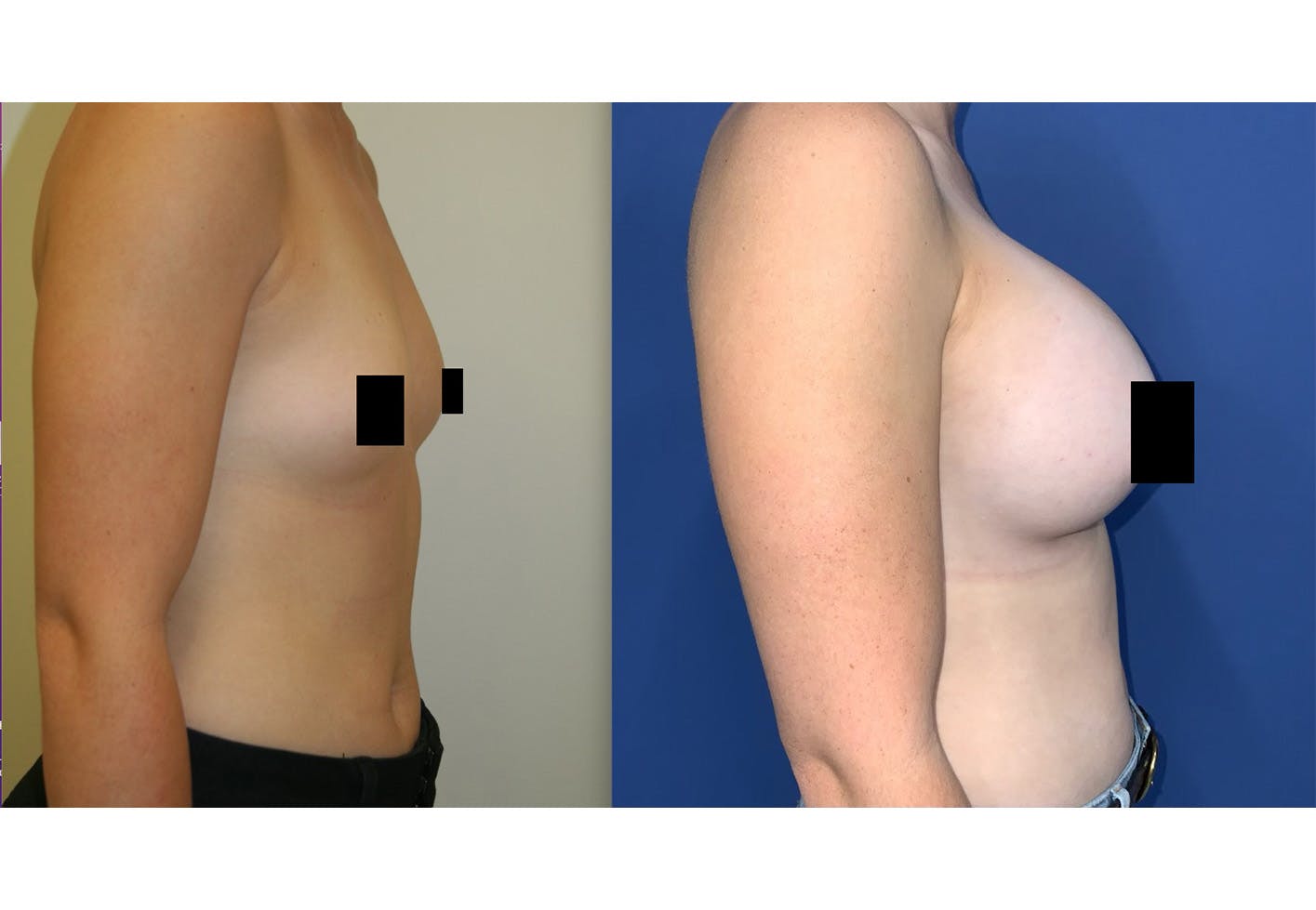 Breast Augmentation Before & After Gallery - Patient 157147218 - Image 3