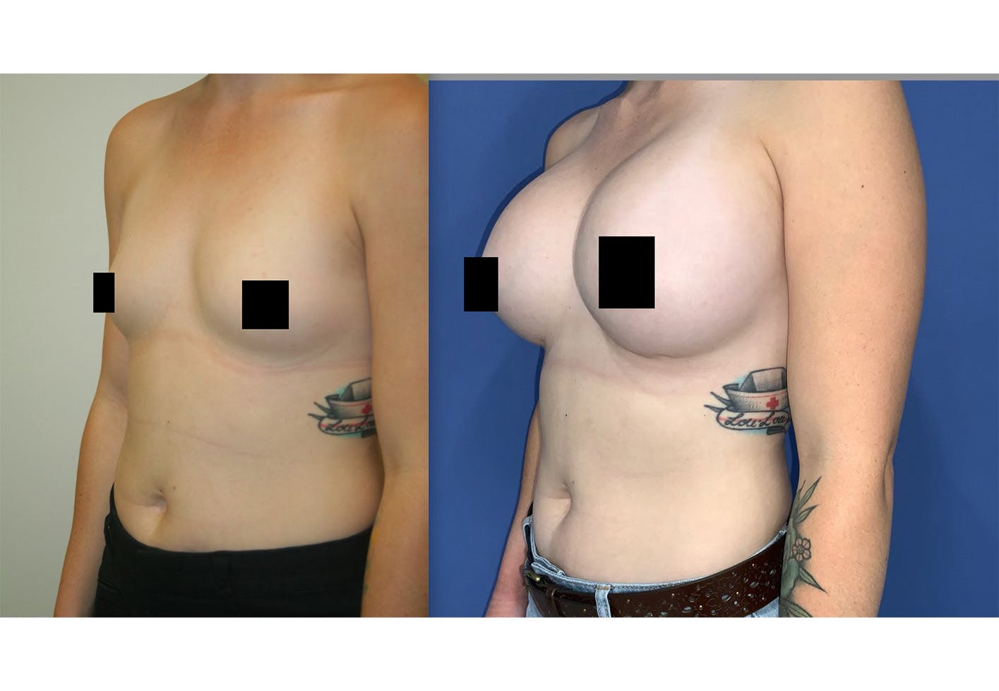 Breast Augmentation Before & After Gallery - Patient 157147218 - Image 2