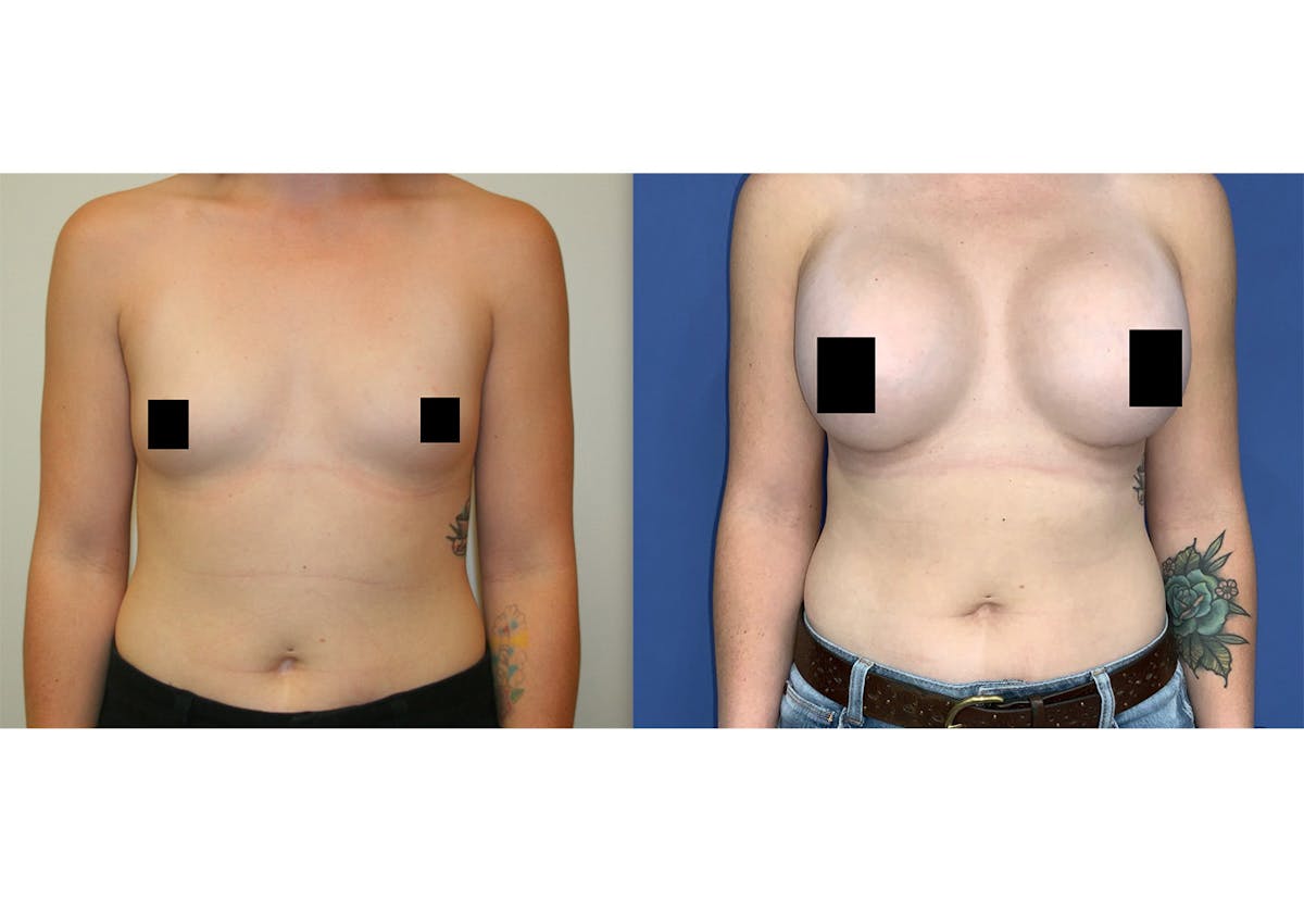 Breast Augmentation Before & After Gallery - Patient 157147218 - Image 1