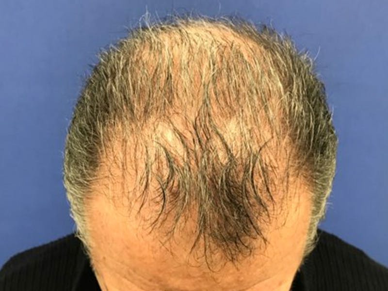 NeoGraft/FUE/Hair Transplant Before & After Gallery - Patient 178871536 - Image 1