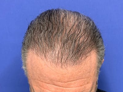 NeoGraft/FUE/Hair Transplant Before & After Gallery - Patient 178871536 - Image 2