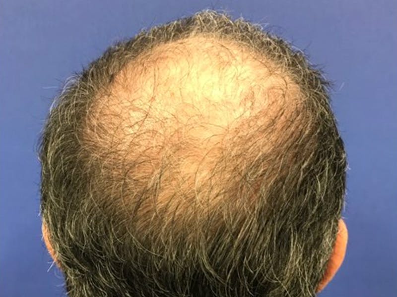 NeoGraft/FUE/Hair Transplant Before & After Gallery - Patient 178871536 - Image 3
