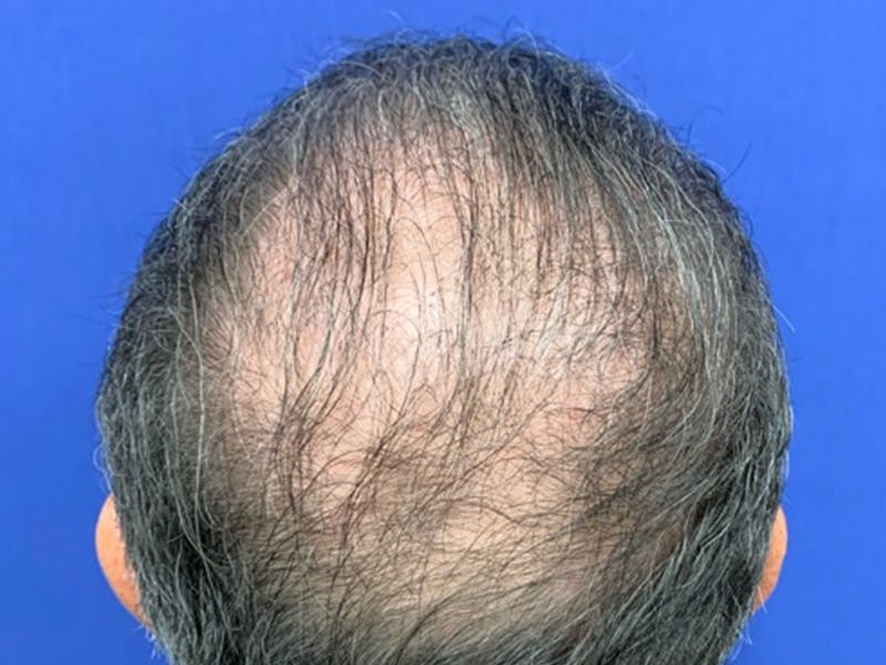 NeoGraft/FUE/Hair Transplant Before & After Gallery - Patient 178871536 - Image 4