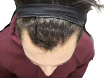 NeoGraft/FUE/Hair Transplant Before & After Gallery - Patient 178871537 - Image 1