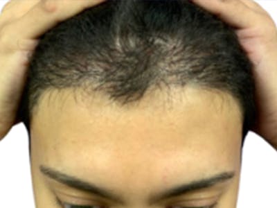 NeoGraft/FUE/Hair Transplant Before & After Gallery - Patient 178871537 - Image 2