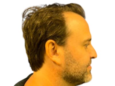 NeoGraft/FUE/Hair Transplant Before & After Gallery - Patient 178871538 - Image 1