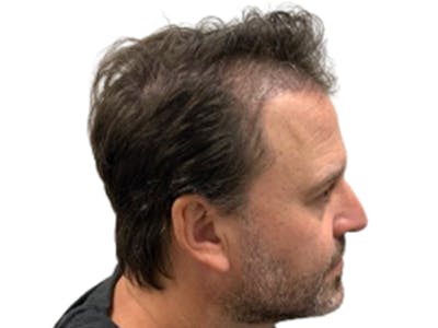NeoGraft/FUE/Hair Transplant Before & After Gallery - Patient 178871538 - Image 2