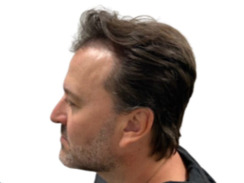 NeoGraft/FUE/Hair Transplant Before & After Gallery - Patient 178871538 - Image 4
