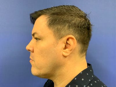 NeoGraft/FUE/Hair Transplant Before & After Gallery - Patient 178871539 - Image 1