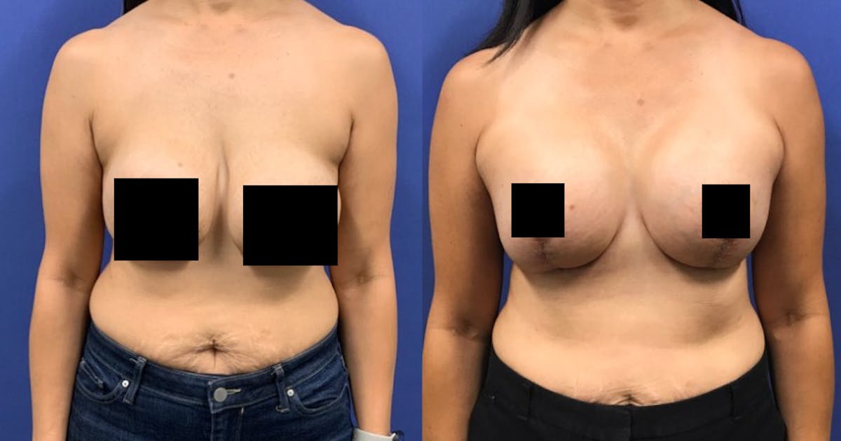 Breast Lift Before & After Gallery - Patient 178871575 - Image 1