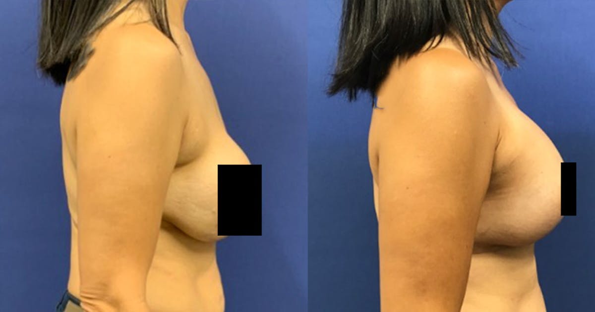 Breast Lift Before & After Gallery - Patient 178871575 - Image 2