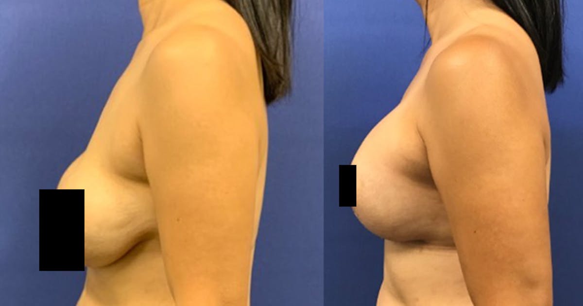 Breast Lift Before & After Gallery - Patient 178871575 - Image 3