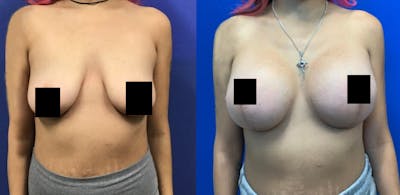 Breast Lift Before & After Gallery - Patient 178871576 - Image 1