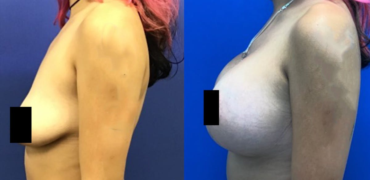 Breast Lift Before & After Gallery - Patient 178871576 - Image 2