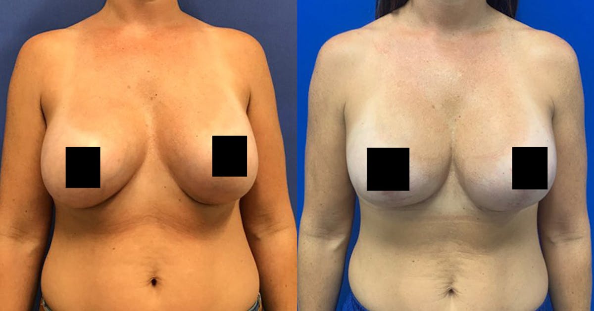 Breast Lift Before & After Gallery - Patient 188329411 - Image 1