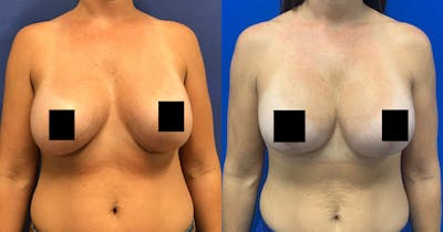 Breast Lift Before & After Gallery - Patient 188329411 - Image 1