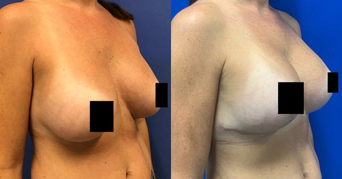Breast Lift Before & After Gallery - Patient 188329411 - Image 2