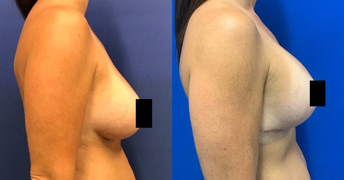 Breast Lift Before & After Gallery - Patient 188329411 - Image 3