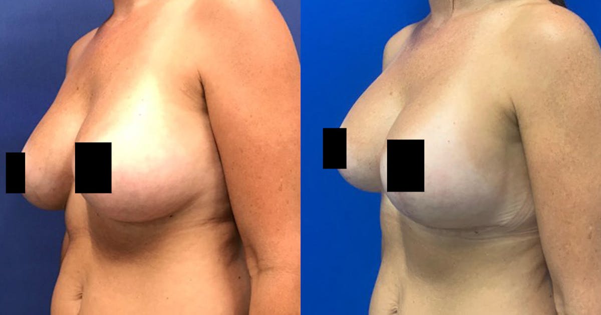 Breast Lift Before & After Gallery - Patient 188329411 - Image 4