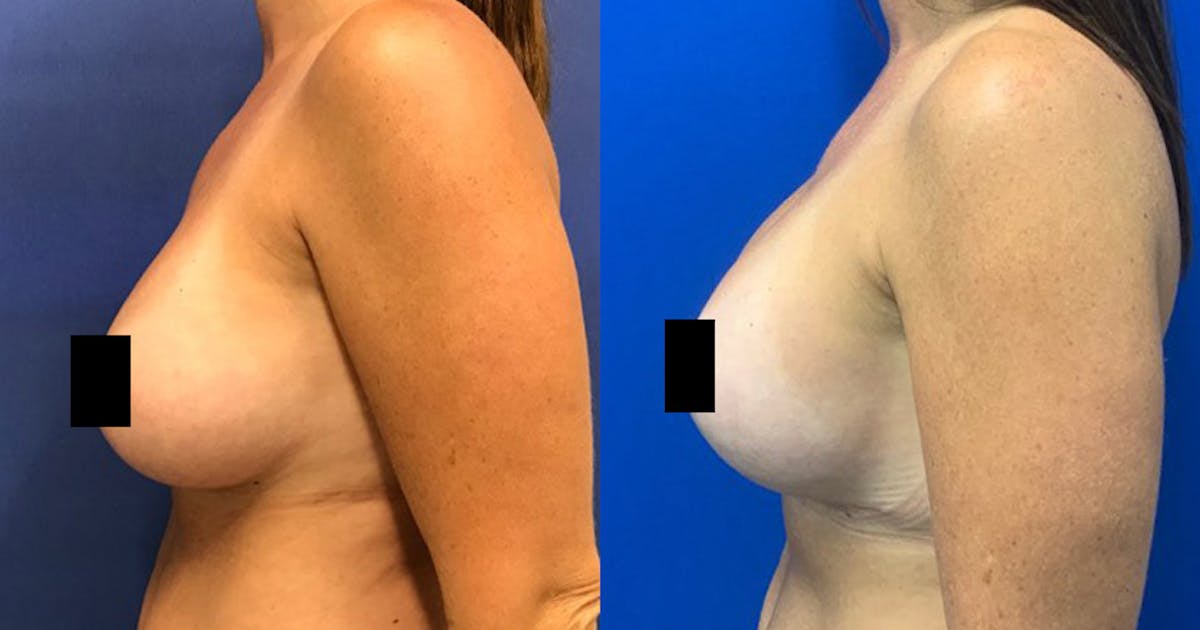 Breast Lift Before & After Gallery - Patient 188329411 - Image 5